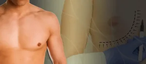 Gynecomastia surgery turkey