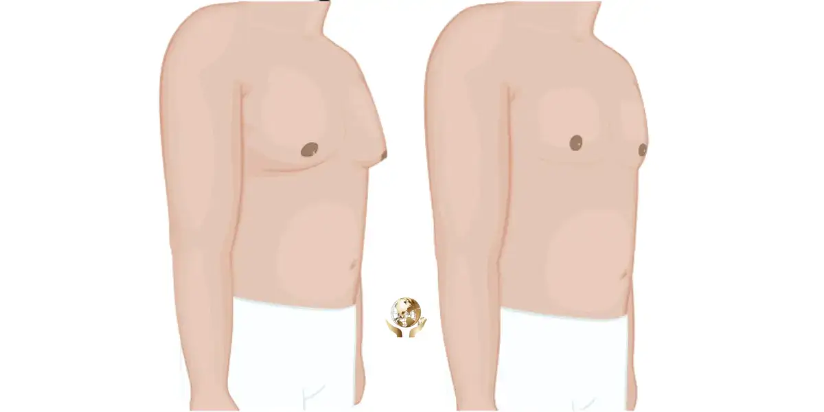 Gynecomastia surgery in Turkey