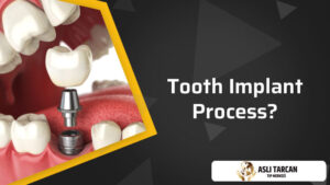 Tooth Implant Process