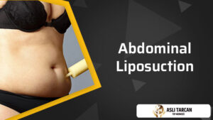 Abdominal Liposuction