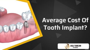 Average Cost Of Tooth Implant