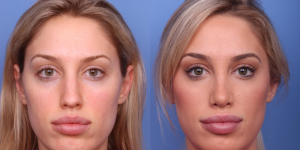 Best Rhinoplasty Surgeon In Arizona