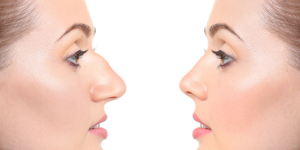 Best Rhinoplasty Surgeon NYC