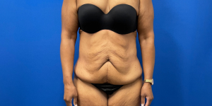 Brazils Laws With Weightloss Surgery