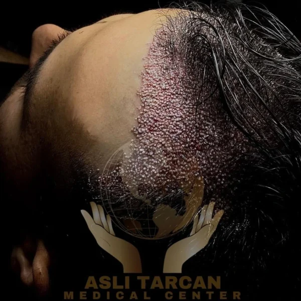 asli tarcan clinic,hair transplant and cosmetic surgery