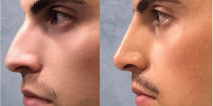 How Long Does Liquid Rhinoplasty Last?