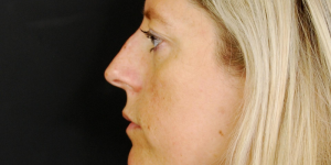 How Long Does Non Surgical Rhinoplasty Last?