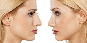 How Long Does Rhinoplasty Take?