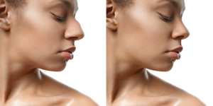 How Long Is Rhinoplasty Recovery?