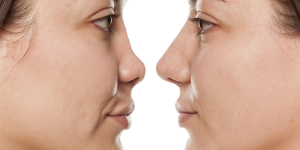 How Much Do Rhinoplasty Cost?