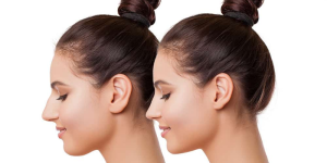 How Much Is Rhinoplasty?