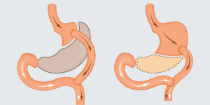 How To Get Covered For Weightloss Surgery?