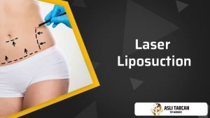 laser-liposuction