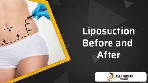 liposuction-before-and-after