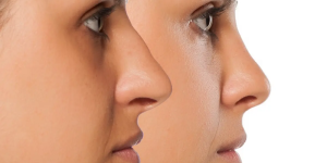 Miami Rhinoplasty