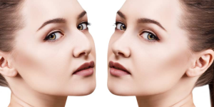 Non Surgical Rhinoplasty Near Me