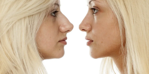 Revision Rhinoplasty Before And After