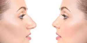 Revision Rhinoplasty Beverly Hills