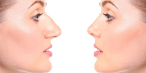 Rhinoplasty