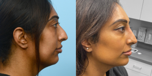 Rhinoplasty Before And After