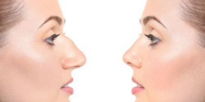 Rhinoplasty Beverly Hills