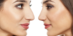 Rhinoplasty Cost With Insurance