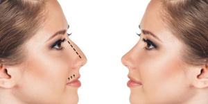 Rhinoplasty Deviated Septum