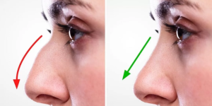 Rhinoplasty Houston