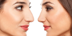 Rhinoplasty Price