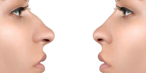 Rhinoplasty Surgeons