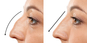 Septo Rhinoplasty