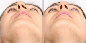 Septoplasty Vs Rhinoplasty