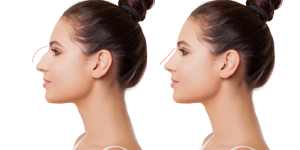 Tip Rhinoplasty Cost