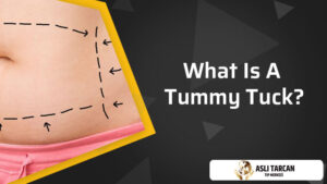 What Is A Tummy Tuck?