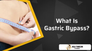 What Is Gastric Bypass?