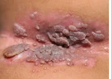 HPV - Human papillóma vírus, Papilloma jelentése az orvosi