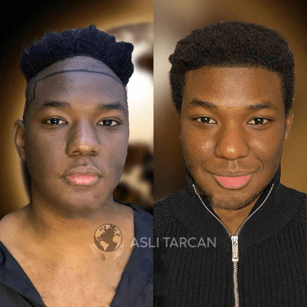 Hair Transplant in Turkey - Before & After - Afro Hair 2