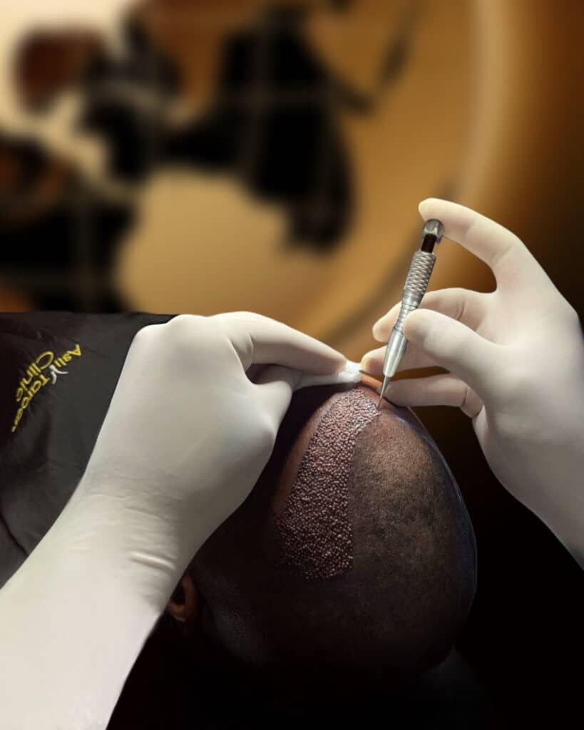 DHI Hair Transplan in Turkey