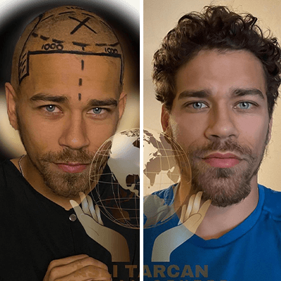 Hair Transplant in Turkey - Before & After - Curly hair