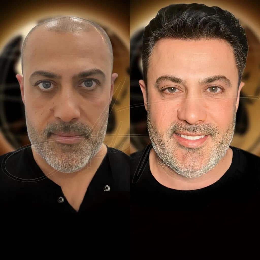 Hair Transplant in Turkey - Before & After - 10 months result