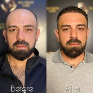 Haartransplantation Beispiel - Vor und Nachher Bilder