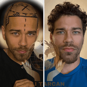 Haartransplantation Beispiel - Vorher-Nachher-Bild