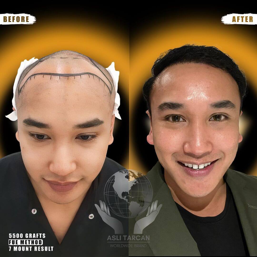 Haartransplantation Tuerkei vorher nachher_5500 Grafts