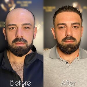 Imagen del antes y después - tras el trasplante capilar