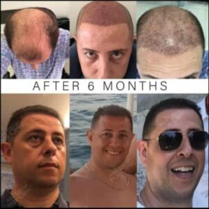 Resultado después de 6 meses