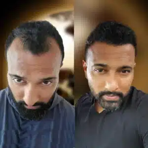 Resultat nach einer Haartransplantation