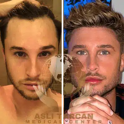 Trasplante capilar turquía antes y después línea frontal