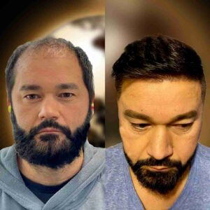 Beispiel einer Haartransplantation - Vorher-Nachher Bilder