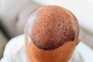 Example - Right after the hair transplant