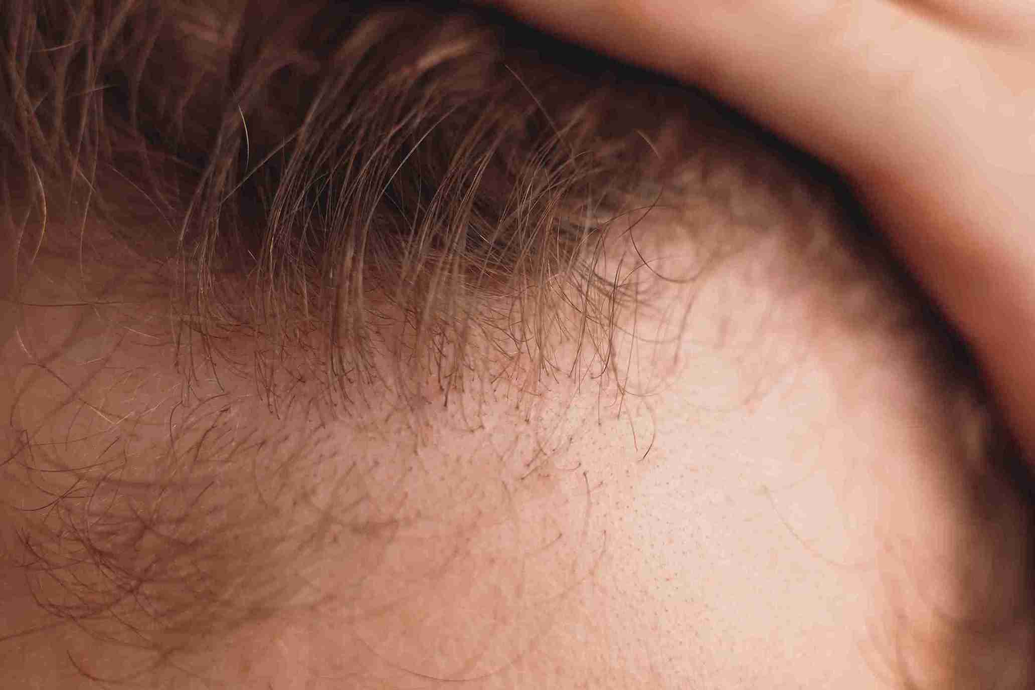 Close-up of a person's high hairline, showing thinning hair near the forehead